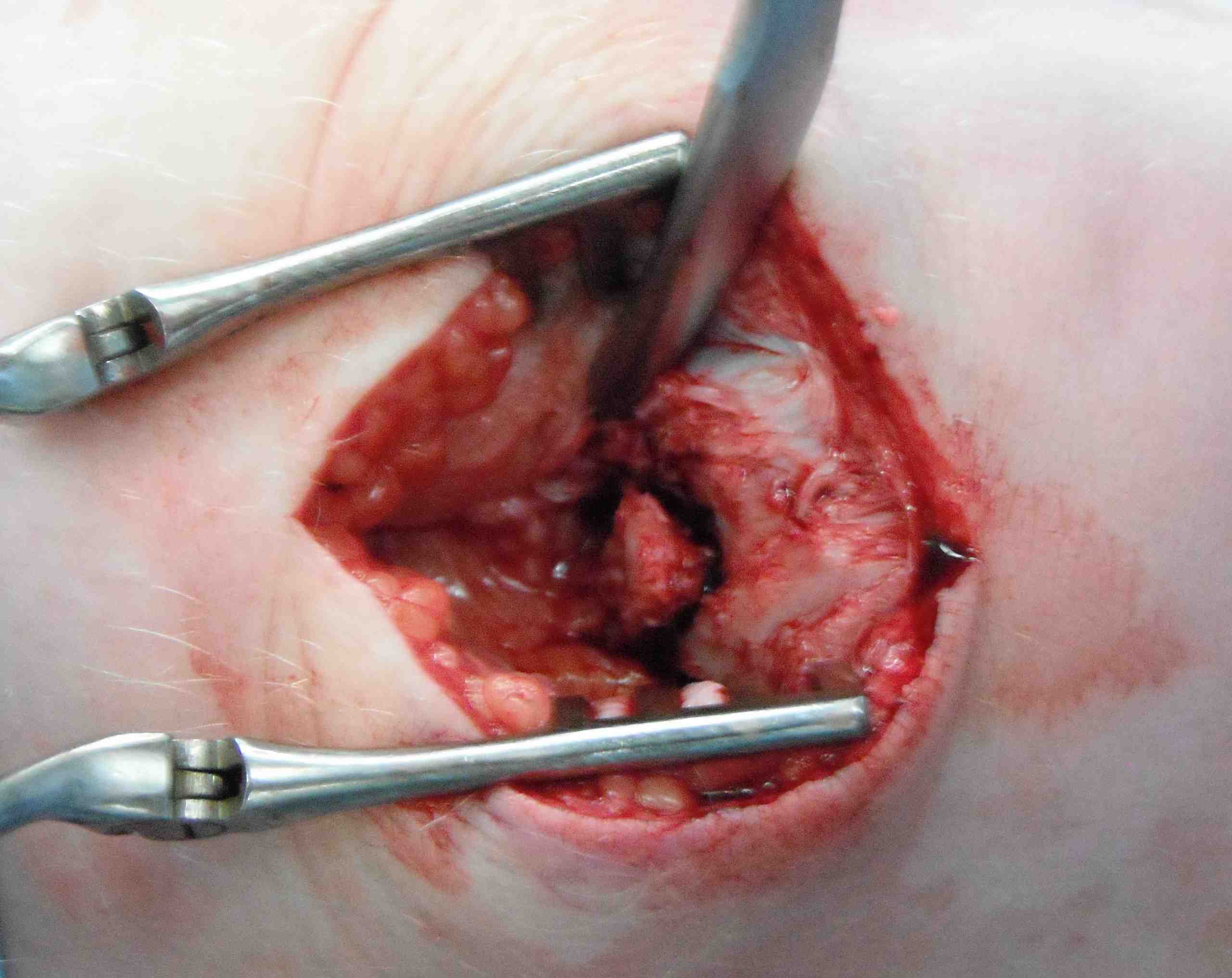 Patella Fracture Nonunion